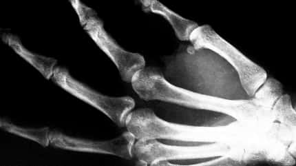 KL Röntgenbild einer Hand KL Röntgenbild einer Hand