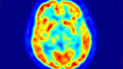 AL Gehirn im PET - Kontrastmittel leuchtet rot AL Gehirn im PET - Kontrastmittel leuchtet rot