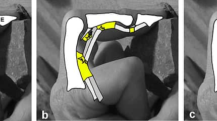 KL_Verletzungen_Ringband_Schema (jpg) KL_Verletzungen_Ringband_Schema (jpg)