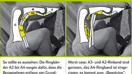 KL_Verletzungen_Ringbandriss_SChema (jpg) KL_Verletzungen_Ringbandriss_SChema (jpg)