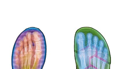 Hallux valgus Fußfehlstellung im Schuh Hallux valgus Fußfehlstellung im Schuh